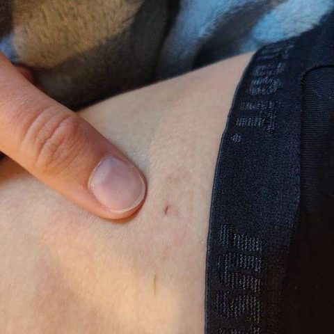 Katie - biopsy scar